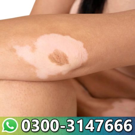How To Fade Burn Scars Naturally